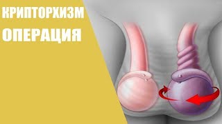 Крипторхизм/Операция