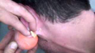 Johns nasty ear pt. 1