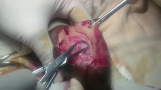 One staged penoplasty-Bilateral scrotal skin flaps