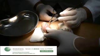 Снятие швов и перевязка после обрезания