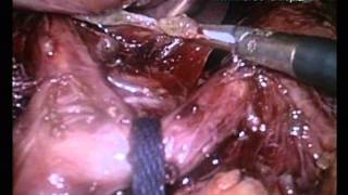Laparoscopic Extended Total Gastrectomy LND D2 OrVil using SVideo