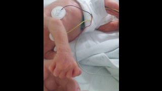 Ребенок родился на 3 месяца раньше \ Преждевременн