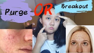 SKIN PURGING VS BREAKOUT | skin purging atau breakout ya ?