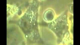 Естественная смерть раковой клетки!