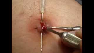 My belly button torture - part.2