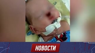 Мать мальчика, лишившегося носа, хочет уголовного наказания для работников роддома