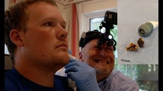 POV Ear wax removal, Headphones make patient deaf
