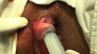 20111217_Rạch áp-xe hậu môn (In-anal abscess drainage)