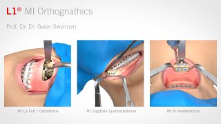 L1® MI Orthognathics (deutsch)