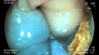 Diagnostic and treatment GI endoscopy