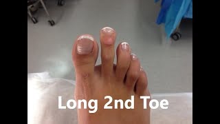 Second (2nd) Toe Longer than Big Toe *Home Treatment*