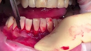 Туннельная вестибулопластика #ХИР.СТОМ.