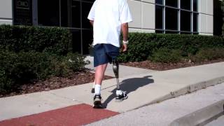 Hip Disarticulation and Hemi-Pelvectomy amputee stories