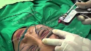 We highlight the techniques in correction of sunken eyes