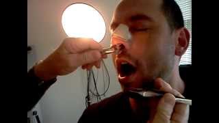 Removal of Splints after Septoplasty Turbinoplasty - Post Op Visit