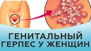 Генитальный герпес у женщин