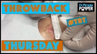 Reminiscing with Dr. Pimple Popper - TBT