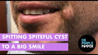 Spitting Spiteful Cyst to a Big Smile