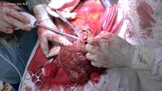Retroperitoneal pseudotumor ( posttraumatic giant  hematoma)