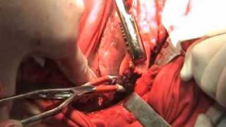 Торакотомия - Thoracotomy