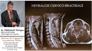 Docteur PENCALET Philippe - Quand opérer un rachis cervical dégénératif ?