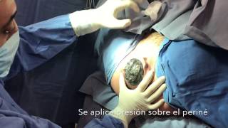 Parte 1: Maniobra Finlandesa para evitar lesiones en la atención del parto