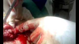 TUMORES DE MAMA-FIBROADENOMA