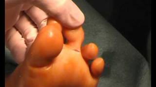 Release flexors for curly toes