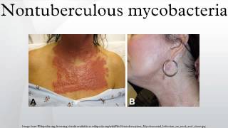 Nontuberculous mycobacteria