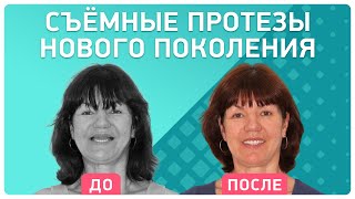 Съемный зубной протез нового поколения ? отзыв пациентки о лечении в клинике Smile-at-Once