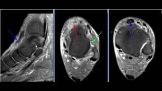MRI Ankle Case 08