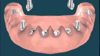 lower bridge with 8 implants