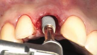 Immediate tooth replacement  Nobel Active Dott. Francesco Mintrone