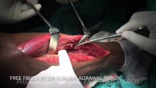 FREE FIBULA BY DR GUNJAN AGRAWAL