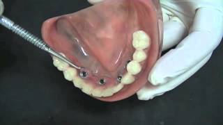 Implante Dentário: Prótese fixa Tipo Protocolo
