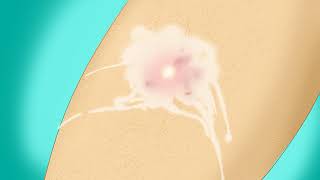 How to Treat a Staph Infection