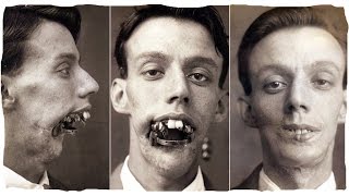 ПЕРВАЯ ПЛАСТИЧЕСКАЯ ОПЕРАЦИЯ ХИРУРГА Harold Gillies КАК ПЕРВАЯ МИРОВАЯ ВОЙНА ПОВЛИЯЛА НА ПЛАСТИЧЕСК