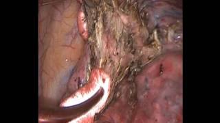Неоднократное удаление метастазов легкого. Repeated metastasectomy lungs.