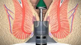 Longo operation steps video