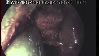 mucor mycosis nose and sinuses debridement