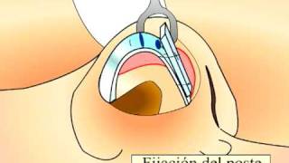 ESTANDARTE, TECNICA DEL DR. FERNANDO PEDROZA