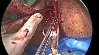 TRANSVERSE VAGINAL SEPTUM