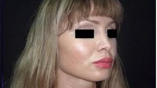 Неудачная Операция. Что Делать, если Испортили Нос? Повторная Ринопластика. Говорит ЭКСПЕРТ
