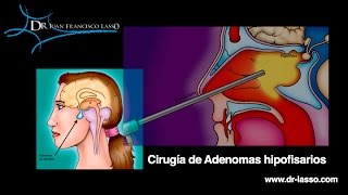 cirugía de tumor hipofisario