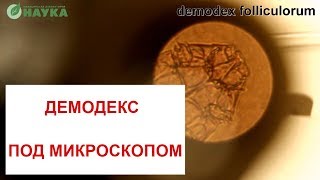 Подкожный клещ Демодекс под микроскопом ?? Demodex Follicles Фото + Видео