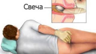 Ректальное применение пентоксифиллина
