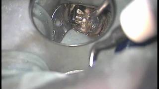Eliminación de perno muñón colado con ultrasonidos