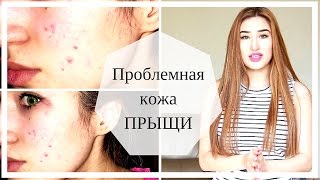 Как побороть ПРЫЩИ ДЕШЕВО 100% Проблемная кожа