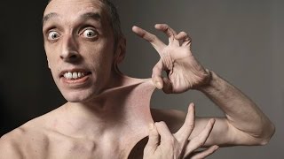 Топ 5 Необычных Синдромов у Людей