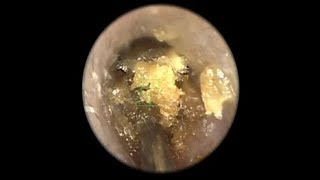Three case of wax treatment
